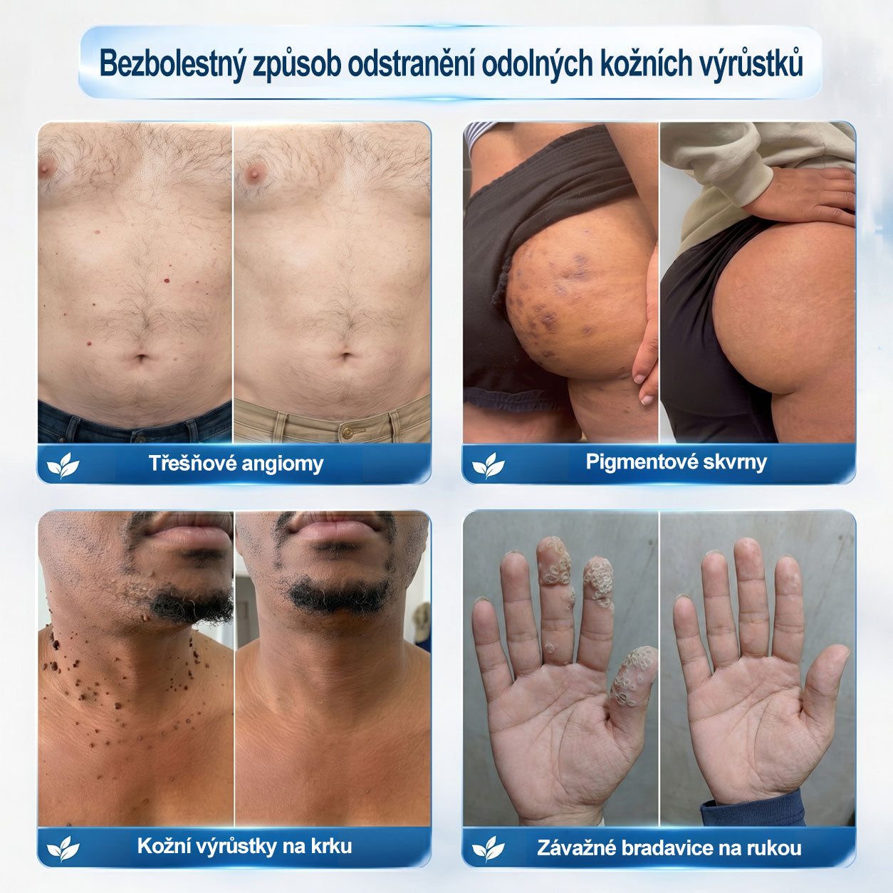 🎁Oficiální značkový obchod |✨✨𝐏𝐢𝐜𝑑𝑜® 𝟩𝖽𝖾𝗻𝗻í 𝘰𝘥𝘴𝘵𝗋𝖺ň𝗈𝗏𝖺č 𝒔𝒌𝒗𝒓𝙣 𝙖 𝙥𝙞𝙜𝙢𝙚𝙣𝙩𝘰𝘷ý𝘤𝘩 𝘴𝘬𝖛𝖗𝖓 (Bezbolestný rollerball bez jizev)🧡